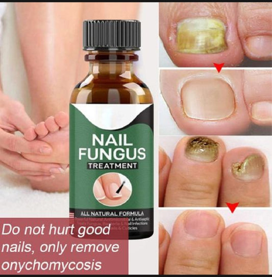 Foot Cure Nail Fungus Treatment – Natural Antifungal Oil for Damaged Nails