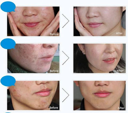 BIOAQUA Skin Care Acne Face Treatment 4 in 1 Acne Series (With Free Sheet Mask)