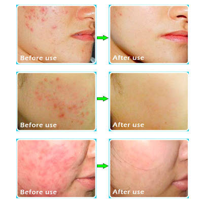 BIOAQUA Skin Care Acne Face Treatment 4 in 1 Acne Series (With Free Sheet Mask)