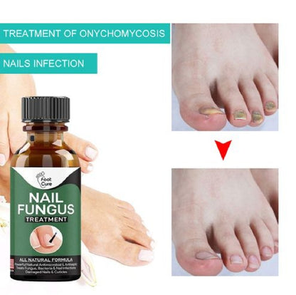 Foot Cure Nail Fungus Treatment – Natural Antifungal Oil for Damaged Nails