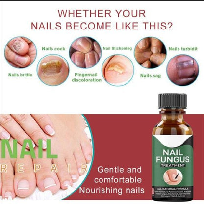 Foot Cure Nail Fungus Treatment – Natural Antifungal Oil for Damaged Nails