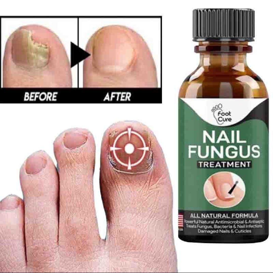 Foot Cure Nail Fungus Treatment – Natural Antifungal Oil for Damaged Nails