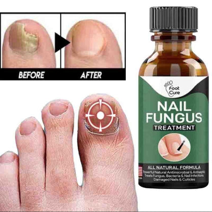 Foot Cure Nail Fungus Treatment – Natural Antifungal Oil for Damaged Nails