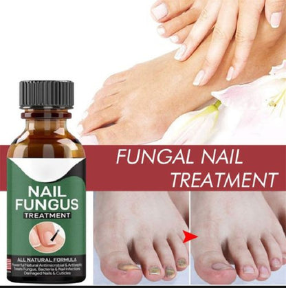 Foot Cure Nail Fungus Treatment – Natural Antifungal Oil for Damaged Nails